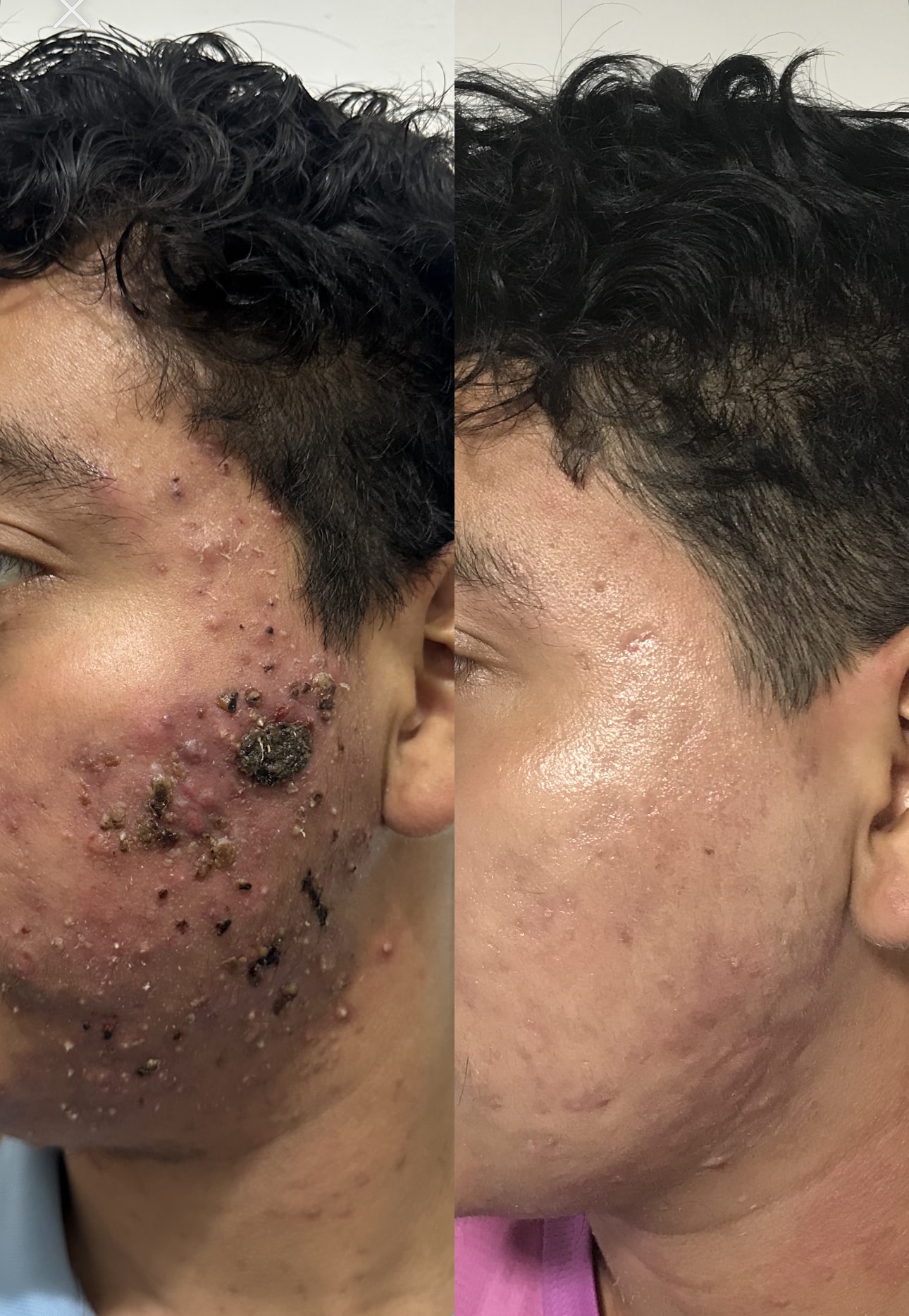 Antes y después tratamiento de acné