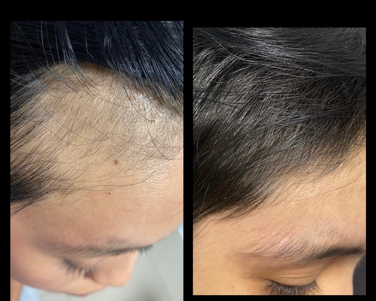 Antes y después tratamiento de alopecia